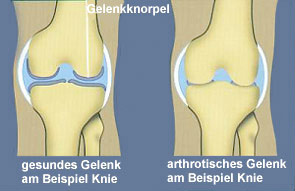Bild Vergleich gesundes und arthrotisches Gelenk am Beispiel Knie
